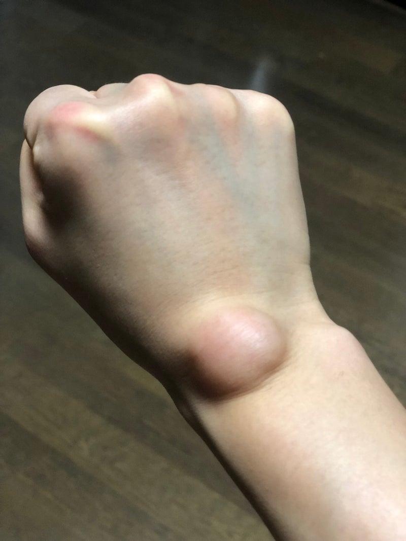 손목결절종 수술 대신 손목보호대로 나은 후기 2