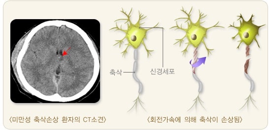 뇌 손상의 8 습관 1