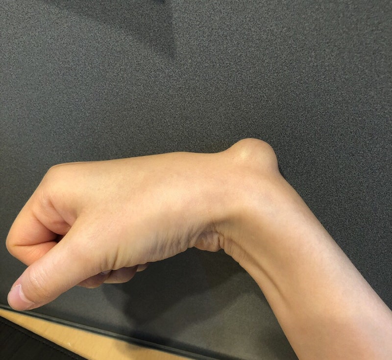 손목결절종 수술 대신 손목보호대로 나은 후기 5