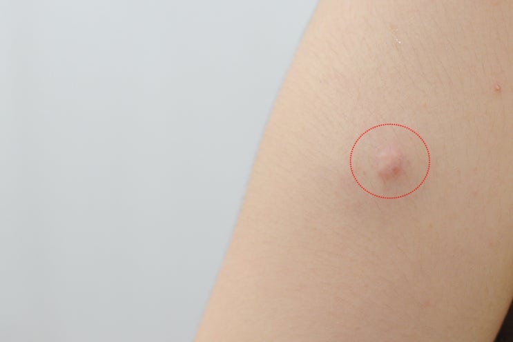  피지낭종 재발? Yes or No