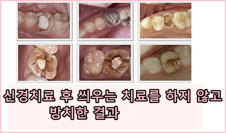 당감동치과*신경치료후크라운으로씌우지않으면?