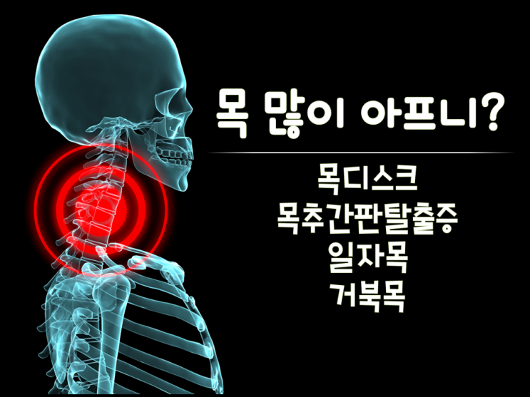 목디스크(목추간판탈출증)교정에 좋은 건강신발