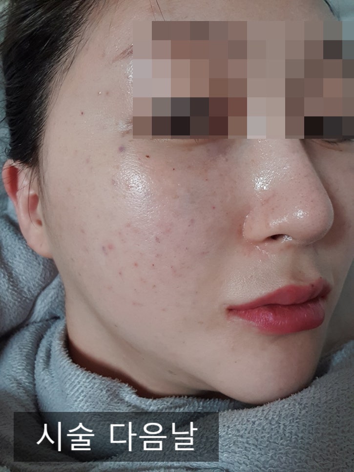 여드름흉터 때문에 강남 쥬베룩 콜라겐스킨부스터 받은 썰 : 네이버 블로그