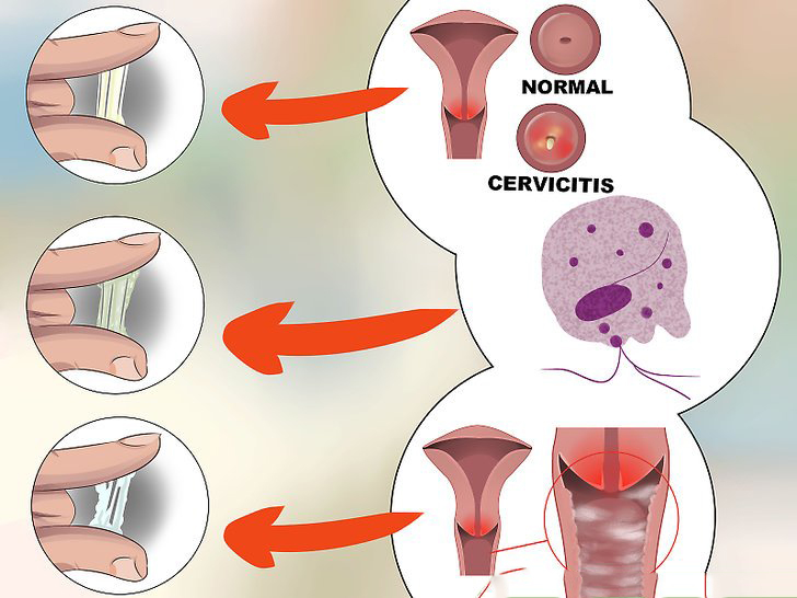  여자 임질 증상 '노랗거나 황록색의 질 분비물과 통증'