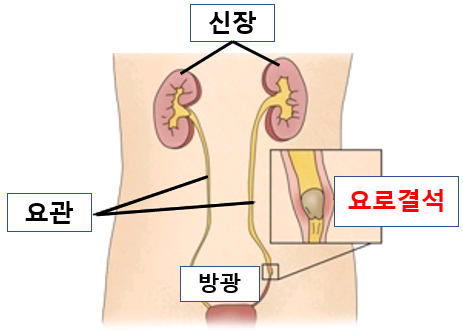 등을 두드리면 아픈 증상, 갈비 5
