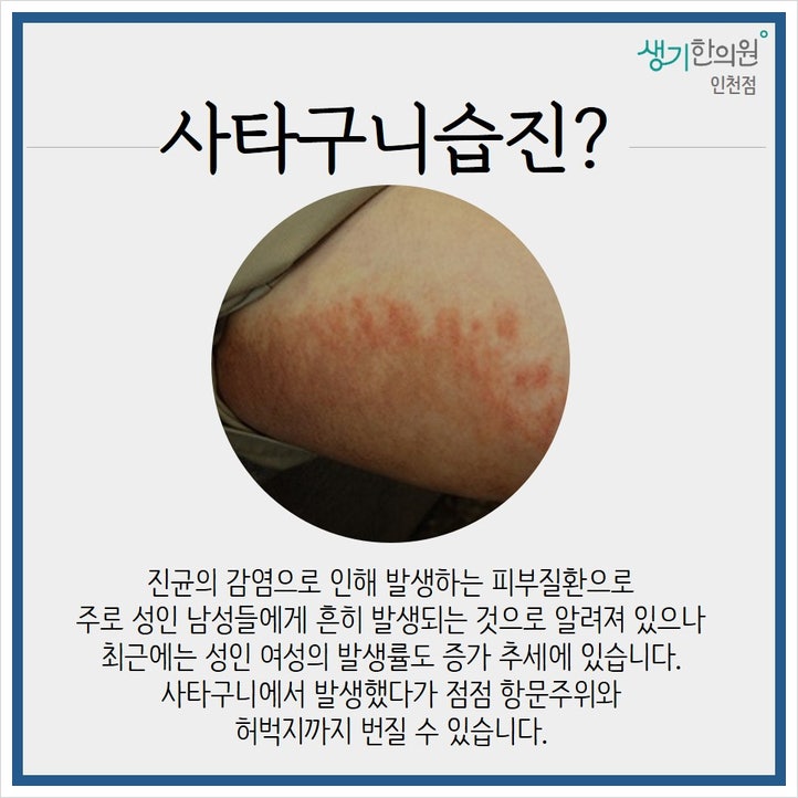 인천 사타구니 습진은 걸을 때마다 아파요