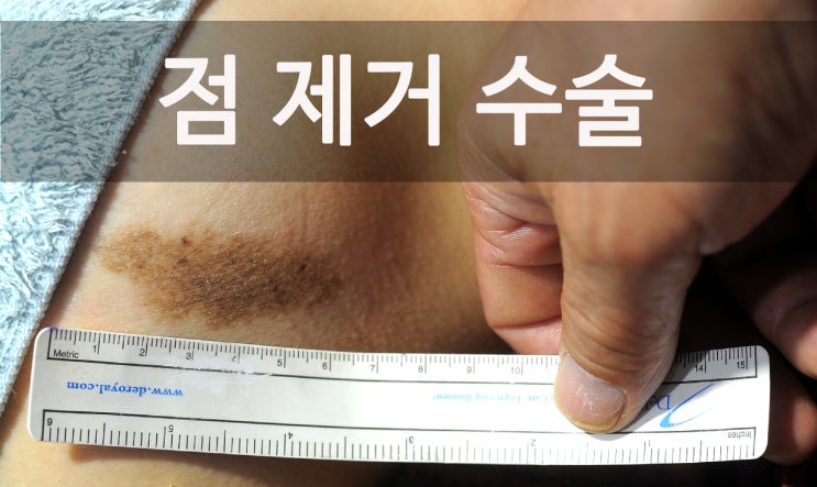  큰점 제거 수술 '옆구리 5cm x 2cm 크기의 점'