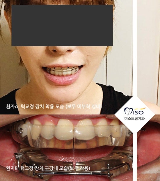 턱디스크, 턱교정 꼭 해주세요! 턱빠짐 턱걸이 장애 턱교정기 비용, 관리방법! 3