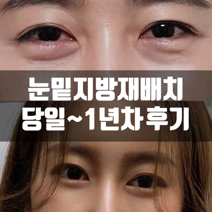 [내돈내받] 눈밑지 1년 후기 부작용??! 부산 눈밑지방재배치 리얼후기 (사진많음)