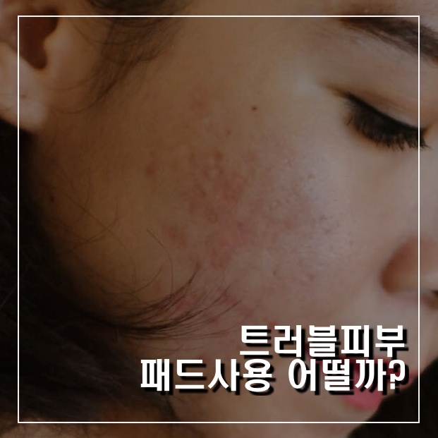  여드름 필링 패드 사용 정말 괜찮을까?
