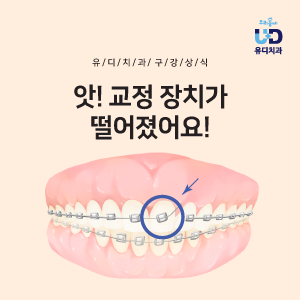 앗! 치아 교정장치 떨어짐 ㅠㅠ 어떻게 하죠? : 네이버 블로그