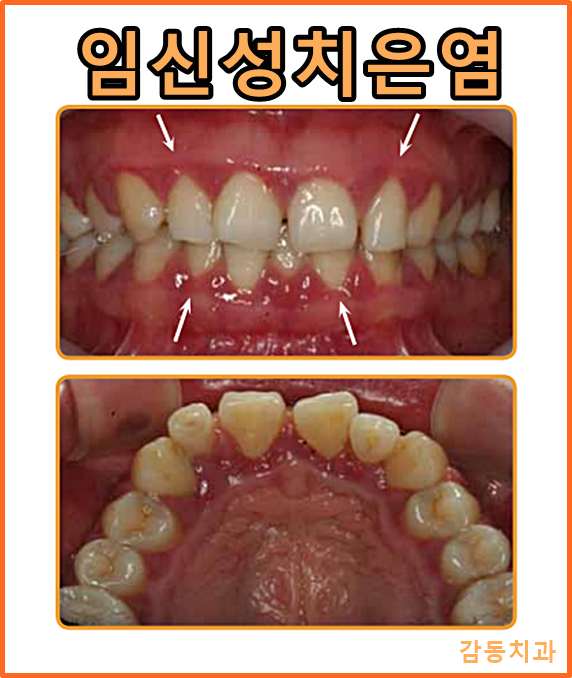  당감동치과*임신중잇몸치료