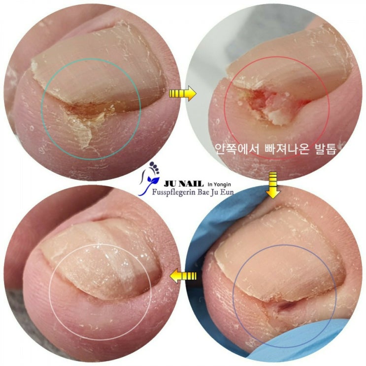 진물과 염증을 동반한 파고드는내성발톱 수술없이 관리했어요/분당용인수원수지보정동백죽전동/주네일/무좀파고드는내향성발톱손톱변형전문네일샵