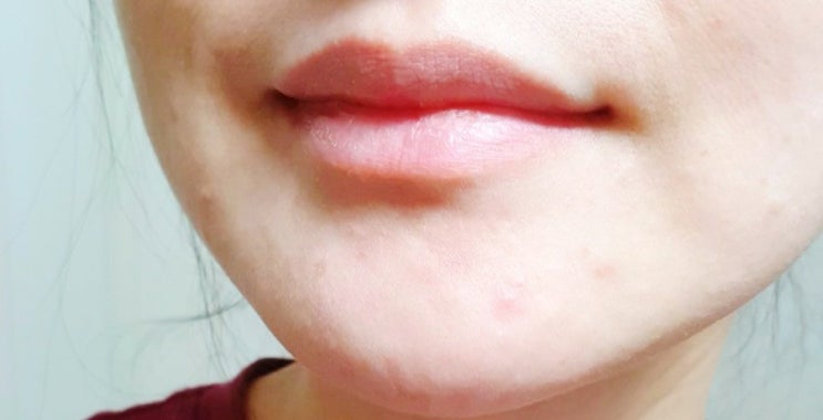  지긋지긋한 [모낭염] 2년동안 완치된 후기 고통받으시는 분들 도움이 되었으면 해요:)
