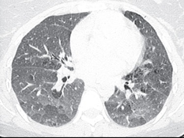 과민성 폐렴 진단 Hypersensitivity Pneumonitis Hp Diagnosis 네이버 블로그