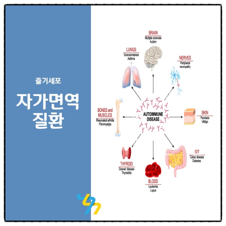  자가면역질환은 줄기세포로?