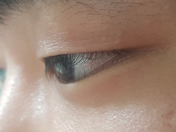 성인 안검내반증 수술후기 대학병원 소견서 검진진단서 의료보험 적용 수술비용 눈의 변화사진 7