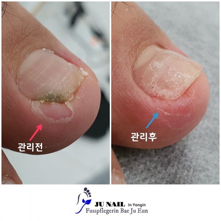 발톱 수술후 내성발톱과염증이 생겼어요./분당용인수원수지보정동백죽전동/주네일/무좀파고드는내향성발톱손톱변형전문네일샵