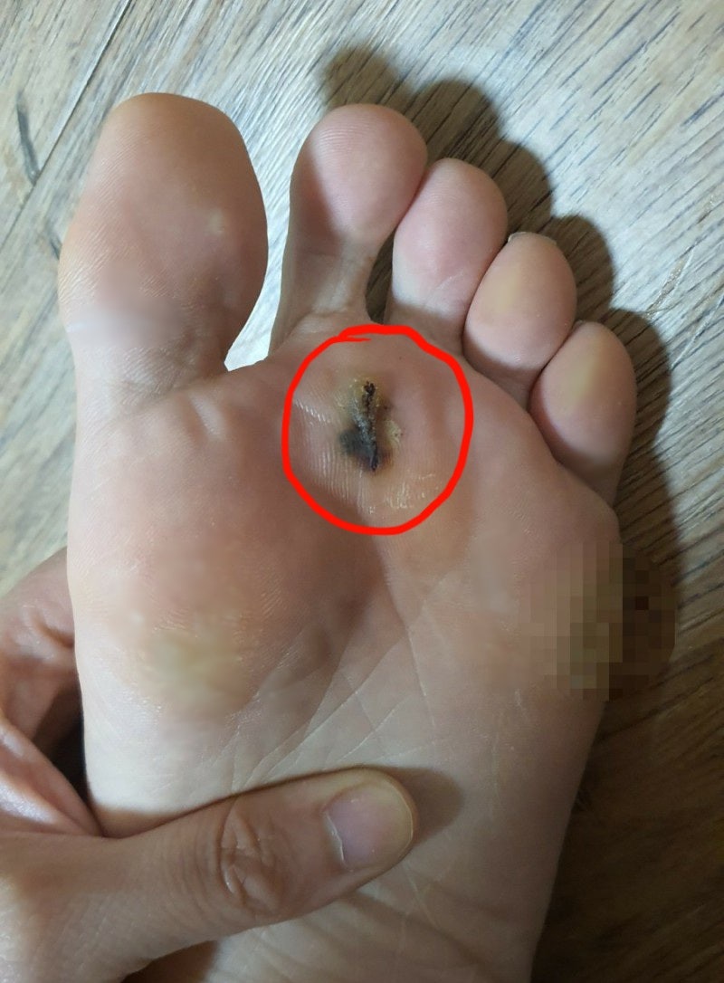 발바닥 티눈 제거 병원 갔다가 자가치료 변경 후 완쾌 꿀팁 대방출 10