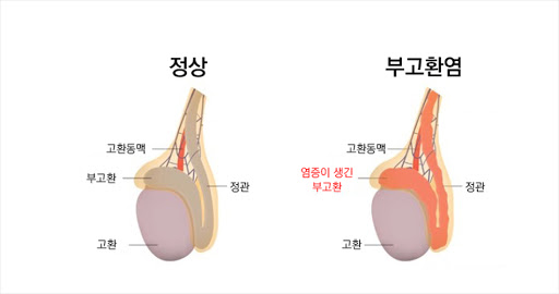 부고환염도 결국 전립선염 친구.