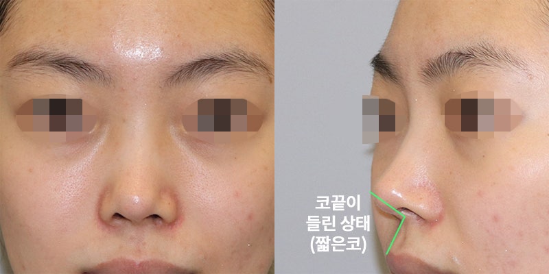짧은 코수술, 유형에 따른 수술방법! (강남치유성형외과) 10