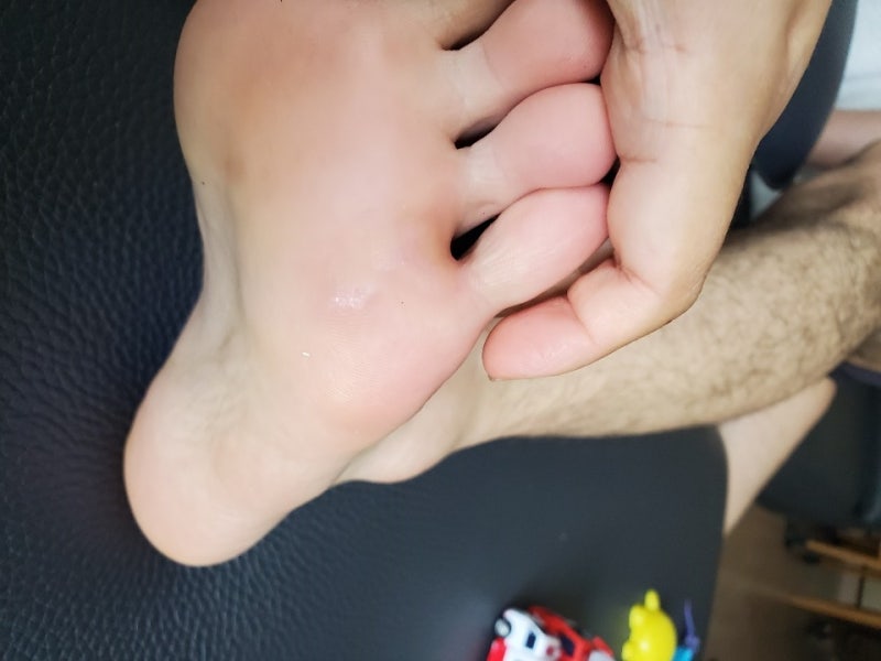 Endwarts 발바닥 사마귀 제거 Andwarts 5주 후에 완치되었습니까?? 검토