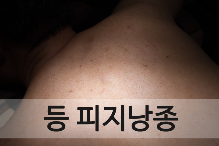  등 피지낭종 '확실하게 완전한 제거 방법'