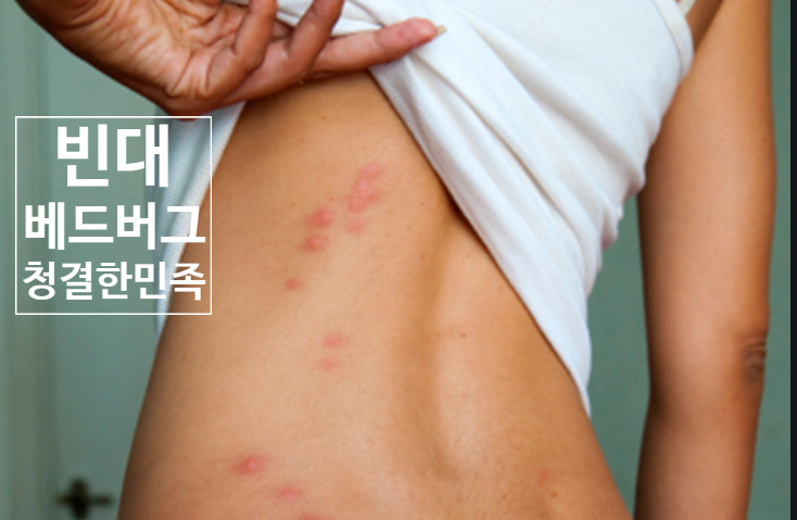  빈대(침대 벌레, 베드 버그, bed bugs) 예방과 완전 퇴치법