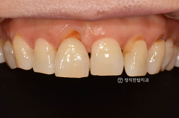 [정자역치과]치아성형과 앞니 레진 재치료