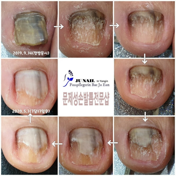 발톱이 까맣게 변하고 변형되어 아픈발톱 관리후기/분당용인수원수지보정동백죽전동/주네일/무좀파고드는내향성발톱손톱변형전문네일샵
