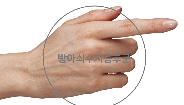  방아쇠수지증후군 들어보셨나요? 치료방법은 무엇이 있을까요?