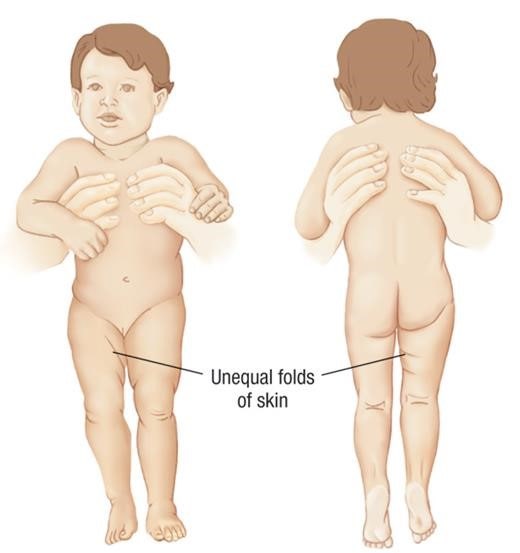 2개월 예방접종 시에 놓치면 안 되는 질환 – 발달성 고관절 이형성증의 진단 : 네이버 블로그 2개월 예방접종 시에 놓치면 안 되는 질환 – 발달성 고관절 이형성증의 진단 : 네이버 블로그