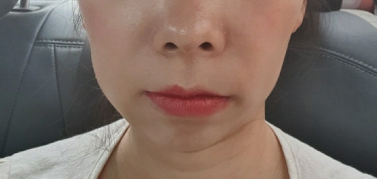  치아교정14) 5.16 월치료 후기