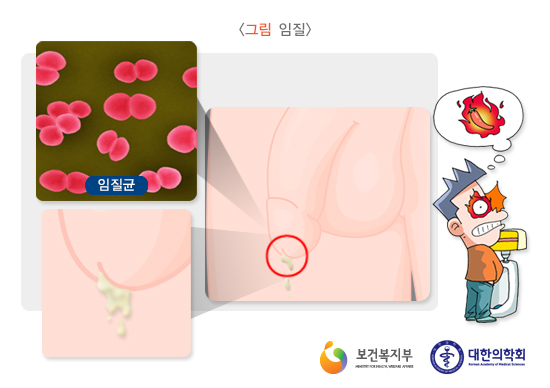  비임균성 요도염으로 바람핀거 걸리곤.. 합니다..