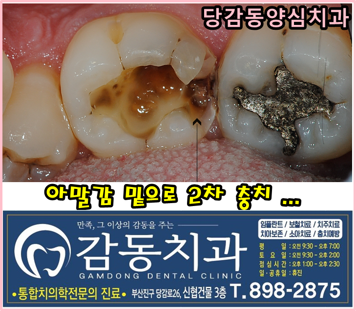  당감동치과*아말감이 사라지는 이유