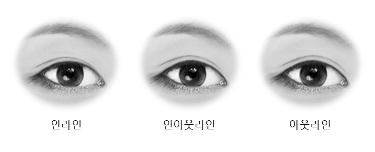 쌍꺼풀 수술, 이것만은 꼭 알고 받자! : 네이버 블로그