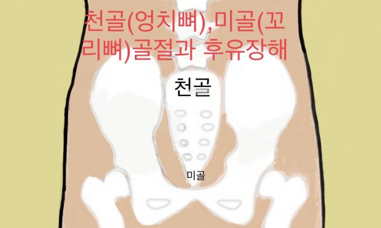 천추골(엉치뼈)미골(꼬리뼈)골절-후유증과 후유장해