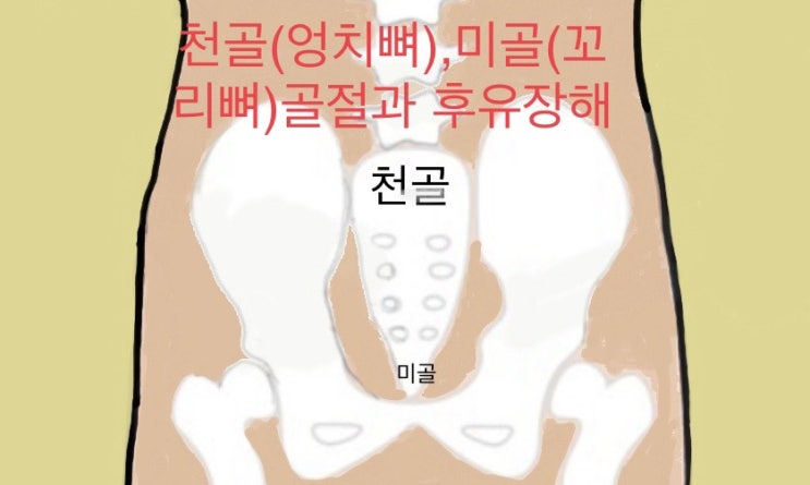  천추골(엉치뼈)미골(꼬리뼈)골절-후유증과 후유장해