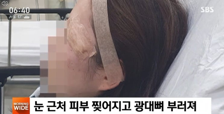 서울역 묻지마 폭행당한 30대女…'광대뼈 함몰'…CCTV 없었다