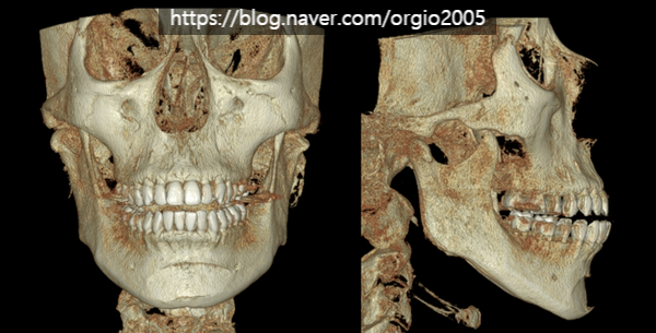 윤곽수술&gt; 실리콘 턱끝 수술 후 오랜기간 발생한 통증