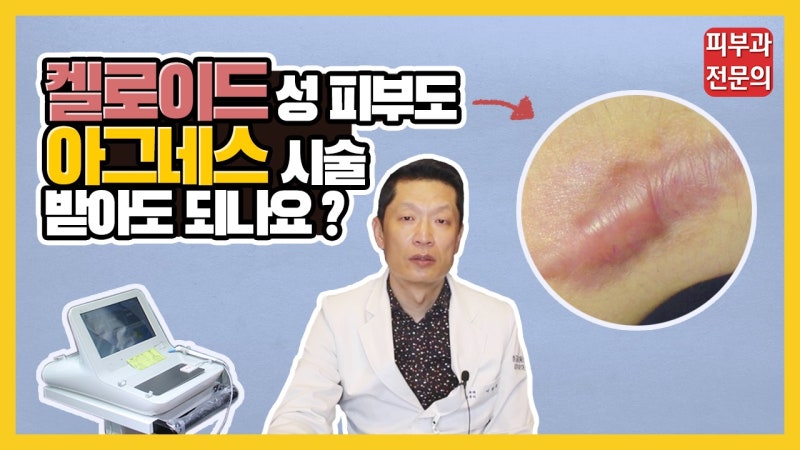 아그네스 여드름 치료 적정 시술 횟수, 켈로이드성 피부도 가능할까?