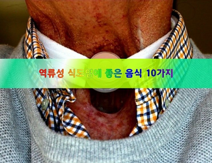 역류성 식도염에 좋은 음식 10가지