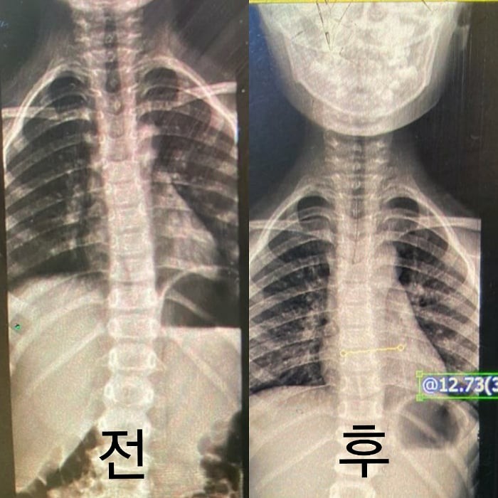  척추측만증~