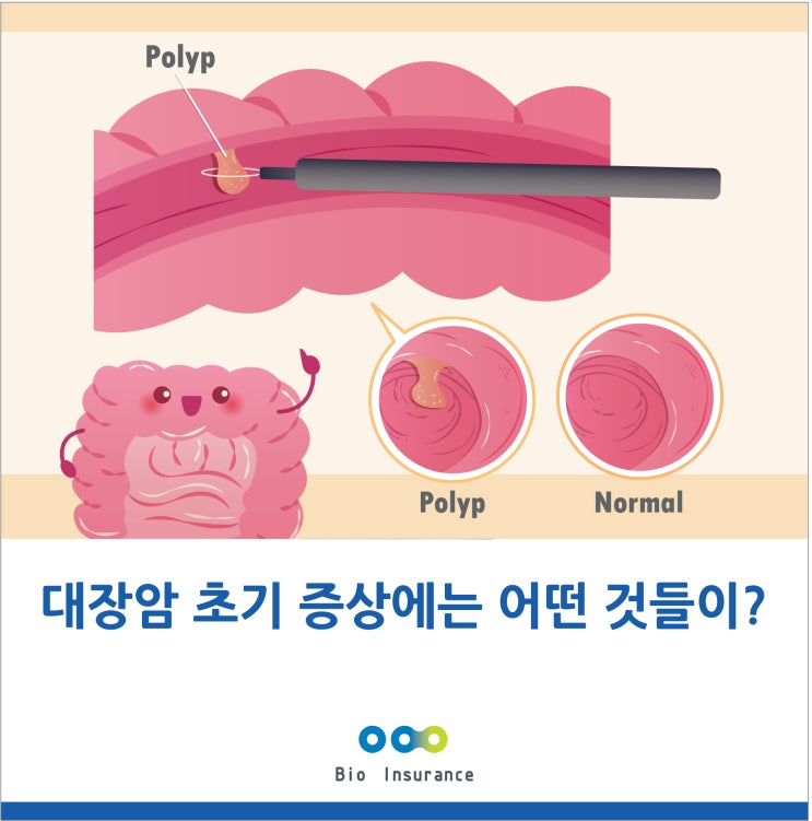  대장암 초기 증상에는 어떤 것들이?