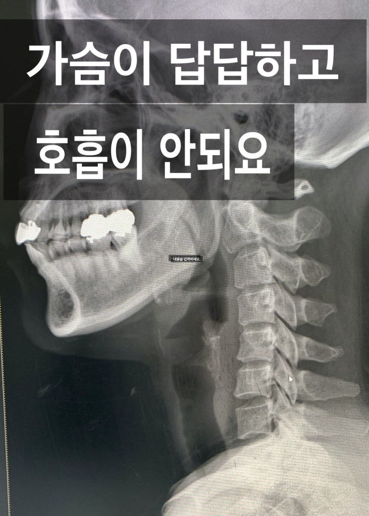  가슴답답 호흡곤란할 땐 뭐 하지?