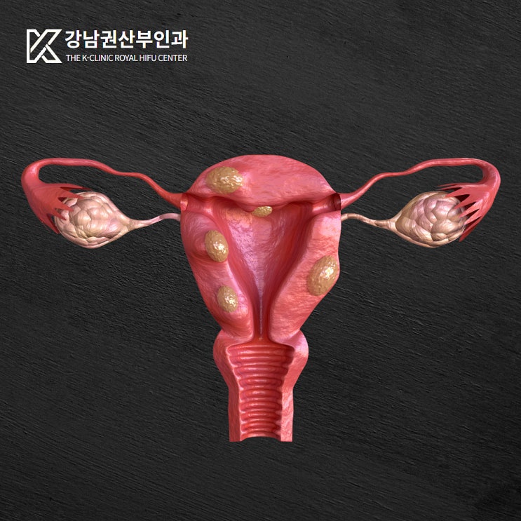  자궁혹 10cm, 민간요법으로 대처하다 개복해야 한다?
