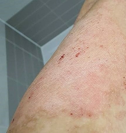 건선약 먹은 3개월 후기 건선약 먹은 3개월 후기