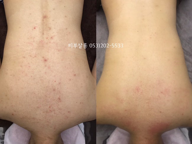 대구피부관리실)달서구 알라딘필링팔여드름자국재생케어리뷰/죽전동피부관리실