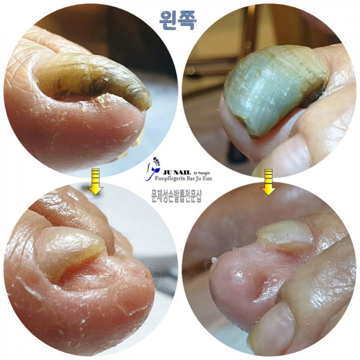 병원 샴푸실에서 할머니의 두껍고 구부러진 무좀발톱 관리해드렸어요./분당용인수원수지보정동백죽전동/주네일/무좀파고드는내향성발톱손톱변형전문네일샵 병원 샴푸실에서 할머니의 두껍고 구부러진 무좀발톱 관리해드렸어요./분당용인수원수지보정동백죽전동/주네일/무좀파고드는내향성발톱손톱변형전문네일샵