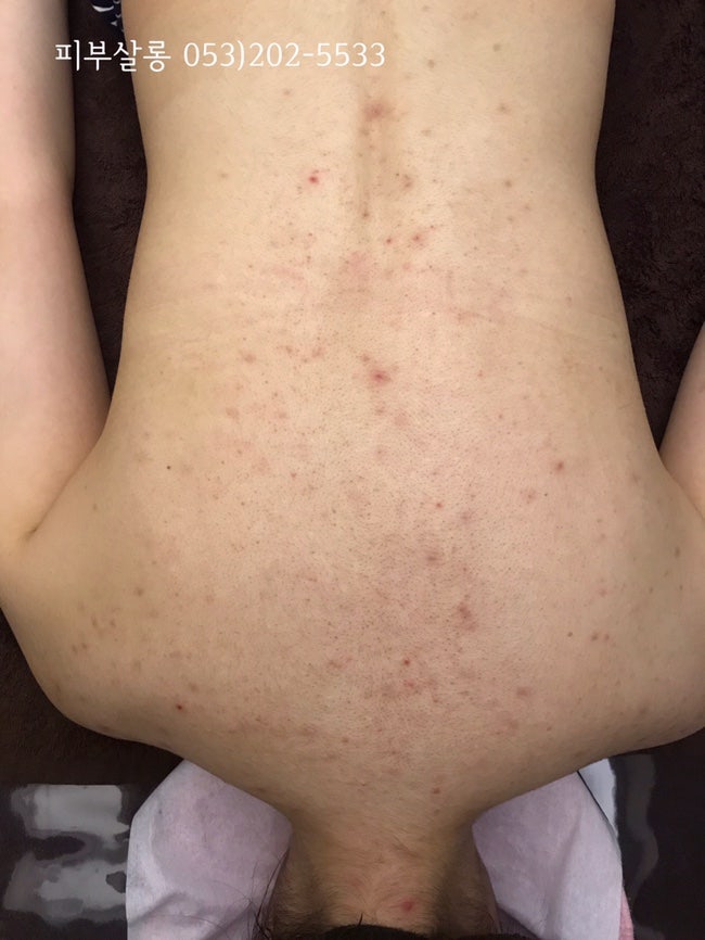 대구피부관리실)달서구 알라딘필링팔여드름자국재생케어리뷰/죽전동피부관리실 3